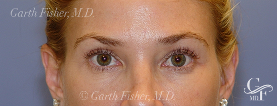 Photo of Patient 04 After Blepharoplasty