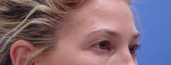 Photo of Patient 04 Before Blepharoplasty