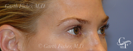 Photo of Patient 04 After Blepharoplasty