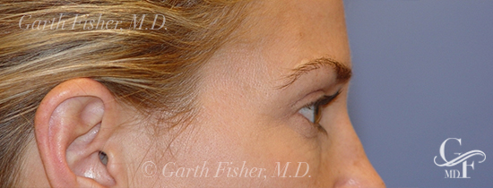 Photo of Patient 04 After Blepharoplasty