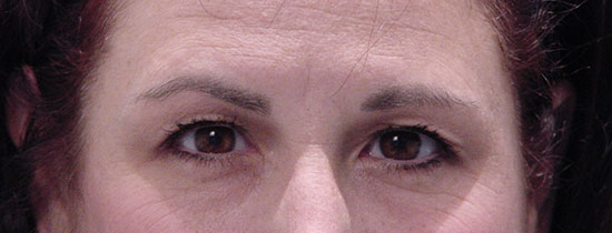 Photo of Patient 05 Before Blepharoplasty