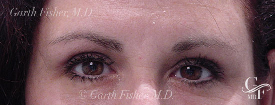 Photo of Patient 05 After Blepharoplasty