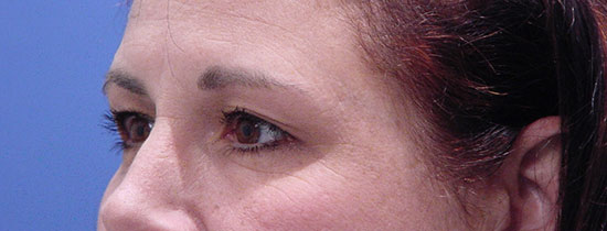 Photo of Patient 05 Before Blepharoplasty