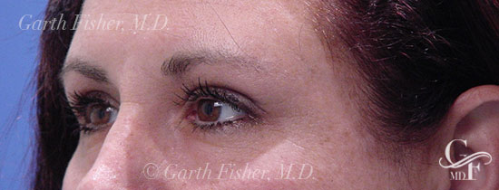 Photo of Patient 05 After Blepharoplasty