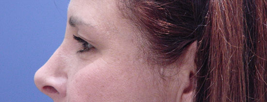 Photo of Patient 05 Before Blepharoplasty