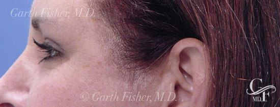 Photo of Patient 05 After Blepharoplasty