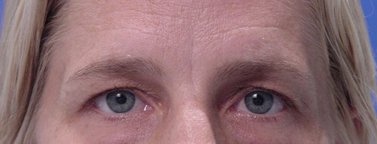 Photo of Patient 06 Before Blepharoplasty