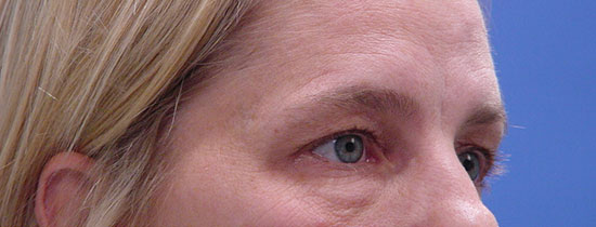 Photo of Patient 06 Before Blepharoplasty