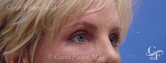 Photo of Patient 06 After Blepharoplasty