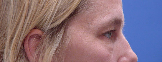 Photo of Patient 06 Before Blepharoplasty