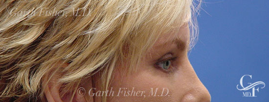 Photo of Patient 06 After Blepharoplasty