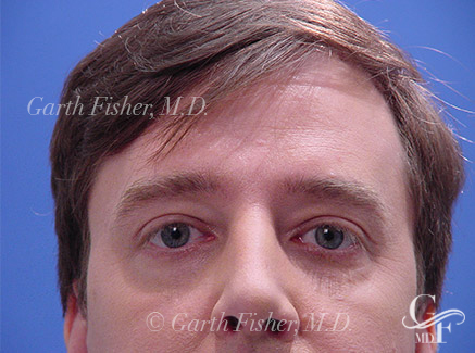 Photo of Patient 01 After Brow Lift