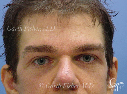 Photo of Patient 02 After Brow Lift