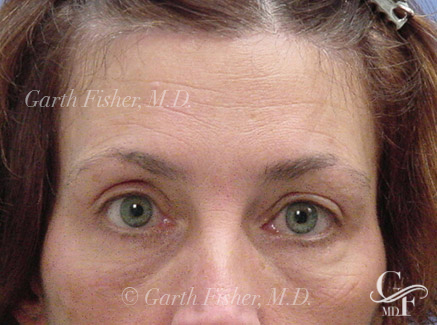 Photo of Patient 06 After Brow Lift