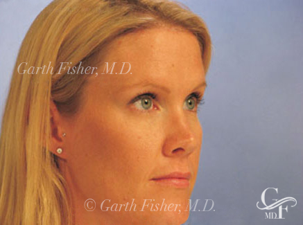 Photo of Patient 07 After Brow Lift