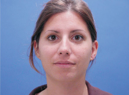 Photo of Patient 01 Before Chin Augmentation
