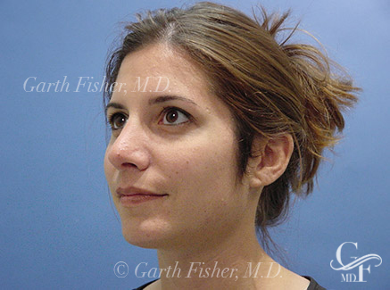 Photo of Patient 01 After Chin Augmentation