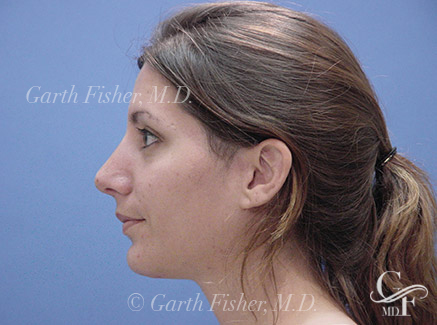 Photo of Patient 01 After Chin Augmentation