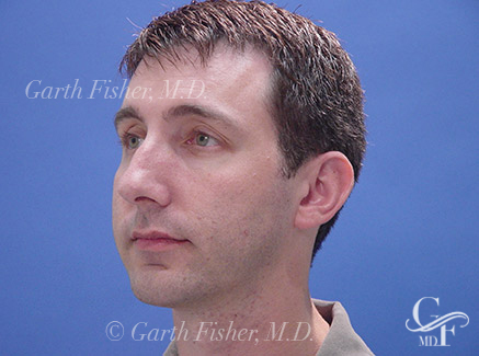 Photo of Patient 03 After Chin Augmentation