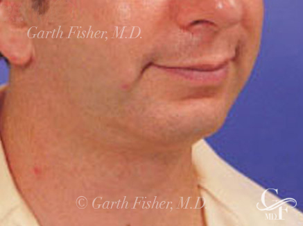 Photo of Patient 04 After Chin Augmentation