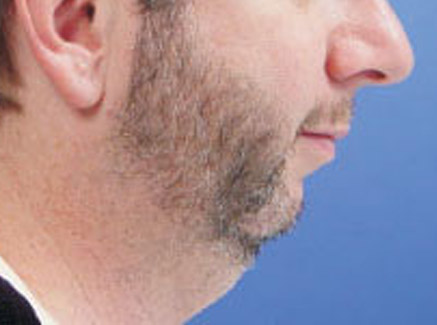 Photo of Patient 04 Before Chin Augmentation