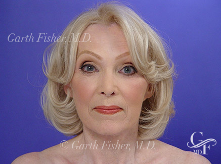 Patient's amazing Facelift results looking diagonally
