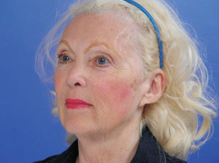 Patient's amazing Facelift results looking sideways