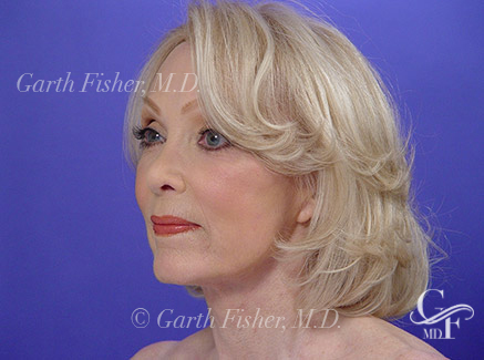 Another Patient's amazing Facelift results looking forward