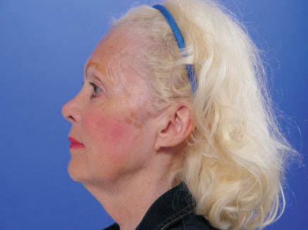 Another Patient's amazing Facelift results looking diagonally