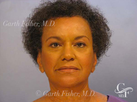 Woman Posing Before Facelift Surgery looking diagonally