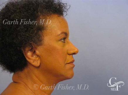 Woman Posing After Facelift Surgery looking sideways