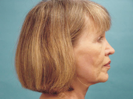 Photo of Patient 06 Before Facelift