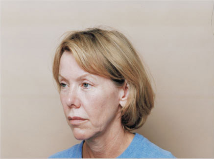 Photo of Patient 10 Before Facelift