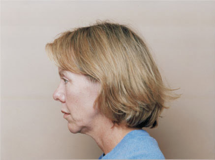 Photo of Patient 10 Before Facelift