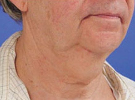 Photo of Patient 01 Before Neck Lift