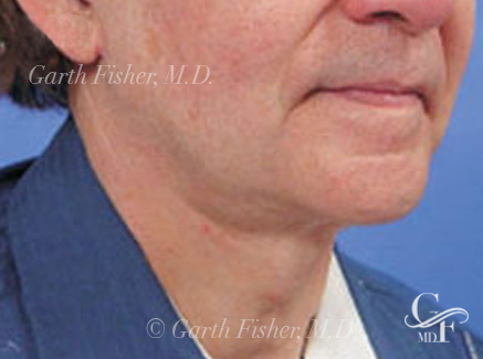 Photo of Patient 01 After Neck Lift