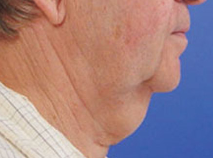 Photo of Patient 01 Before Neck Lift