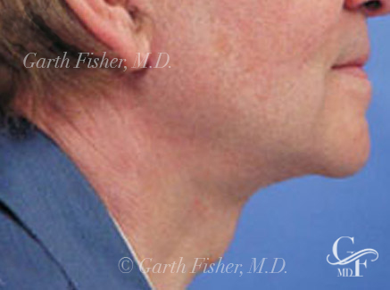 Photo of Patient 01 After Neck Lift