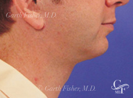 Photo of Patient 02 After Neck Lift