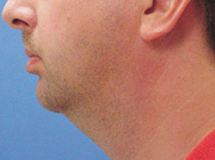 Photo of Patient 03 Before Neck Lift