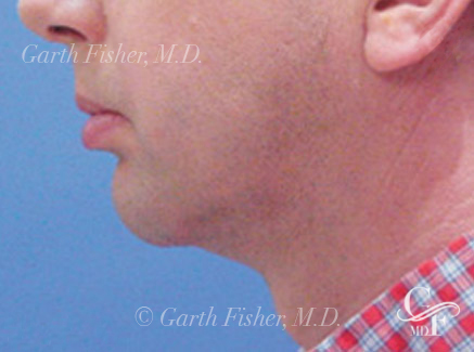 Photo of Patient 03 After Neck Lift