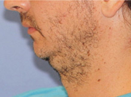 Photo of Patient 04 Before Neck Lift