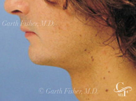 Photo of Patient 04 After Neck Lift