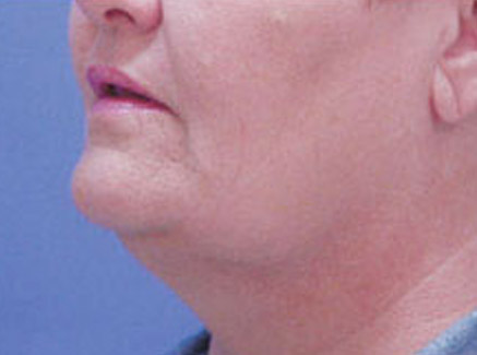 Photo of Patient 05 Before Neck Lift
