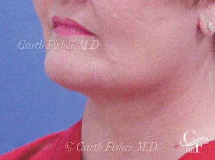 Photo of Patient 05 After Neck Lift