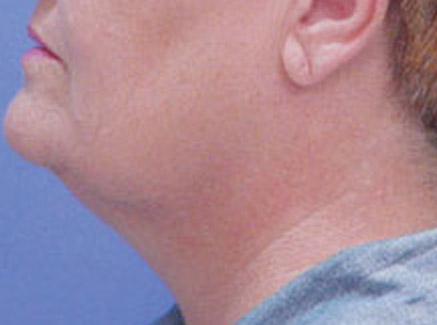 Photo of Patient 05 Before Neck Lift