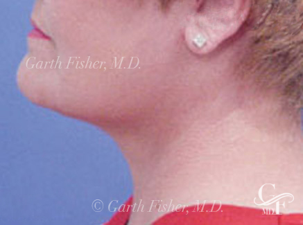 Photo of Patient 05 After Neck Lift