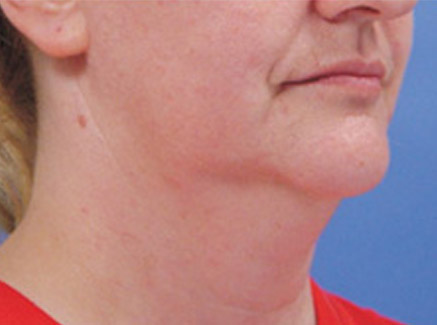 Photo of Patient 06 Before Neck Lift