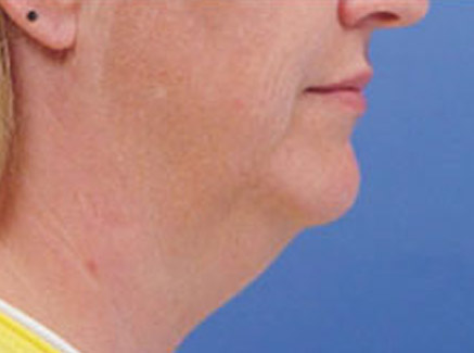 Photo of Patient 07 Before Neck Lift