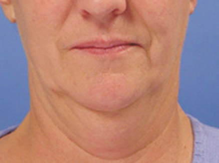 Photo of Patient 08 Before Neck Lift
